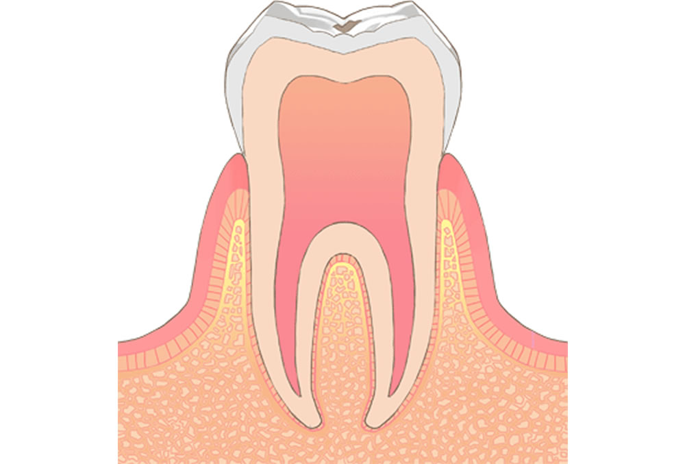 初期症状の虫歯