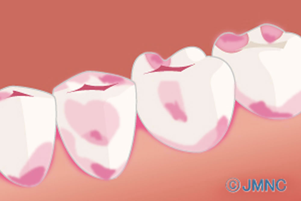 う蝕検知液による虫歯の染め出し