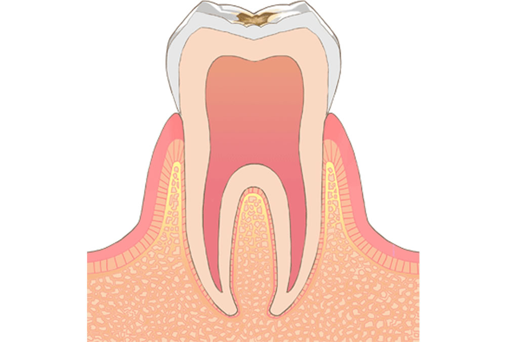 歯の表面(エナメル質)の虫歯