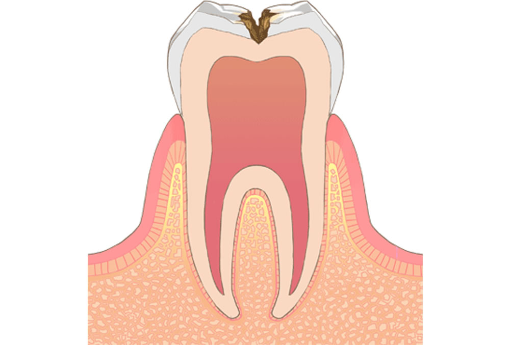 歯の内部(象牙質)の虫歯
