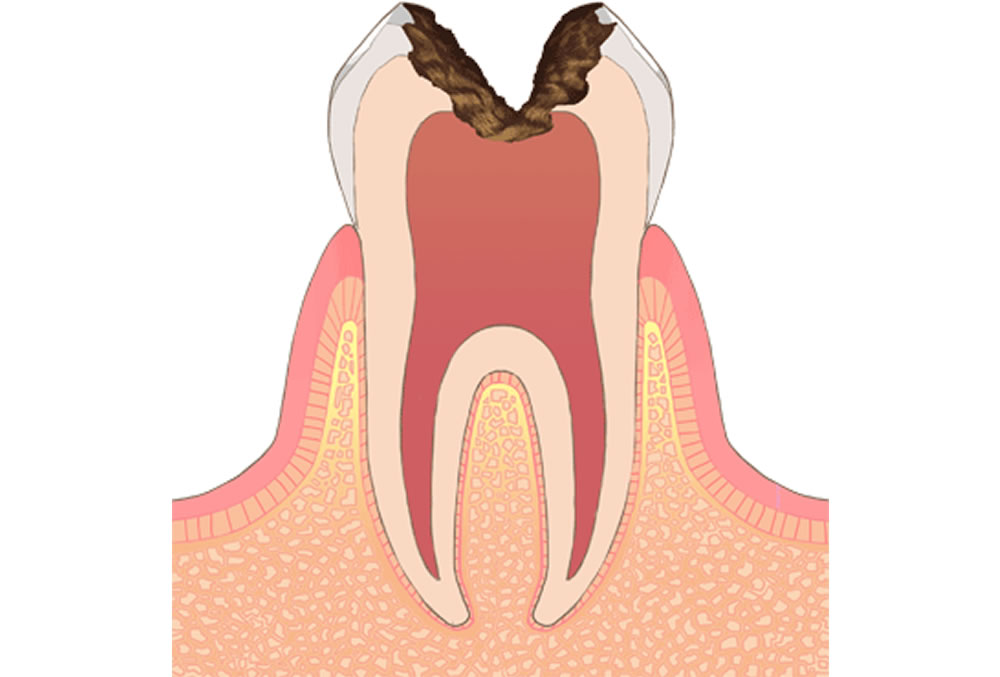 歯の中枢(神経)に達した虫歯