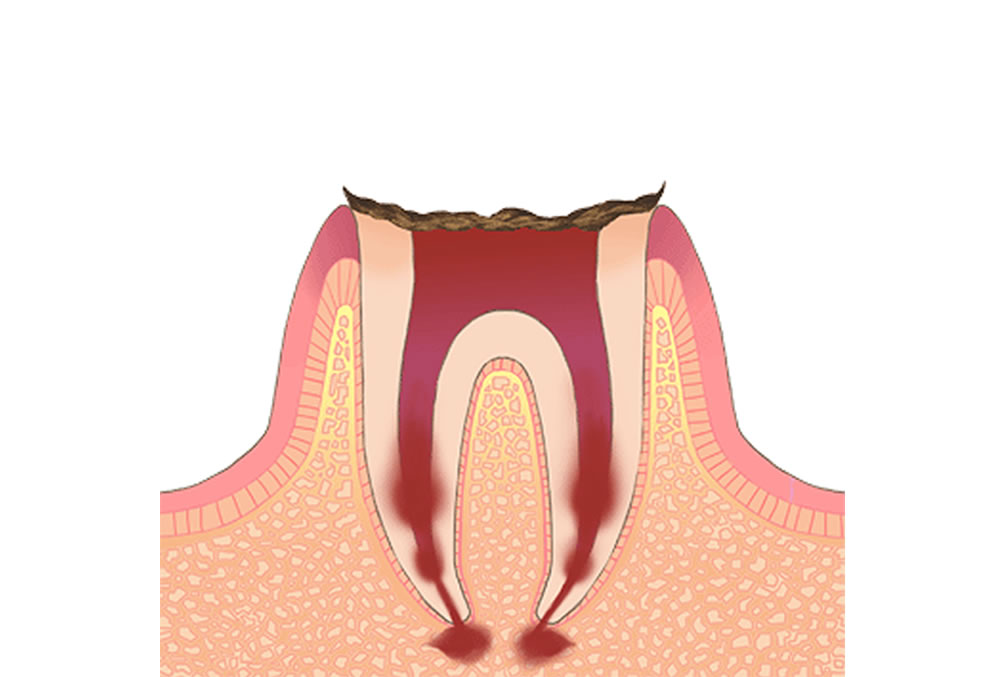 【C4】歯根しか残存していない歯の虫歯