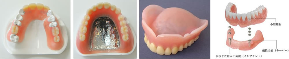 入れ歯治療