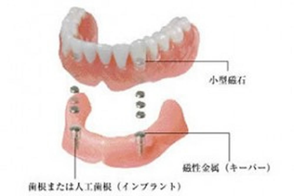 BPSデンチャー