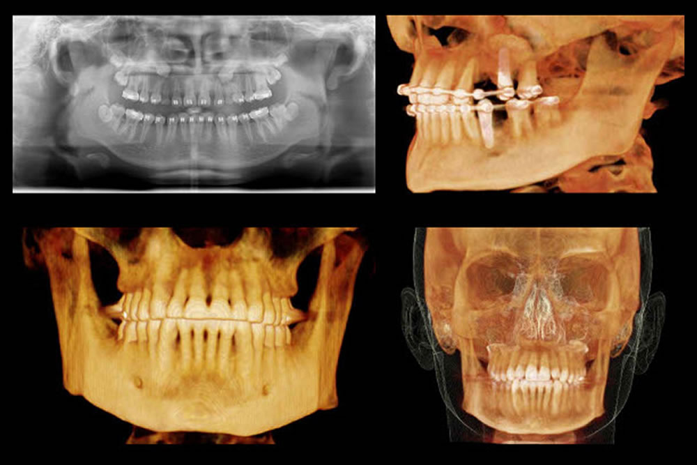 歯科用CTでの精密検査