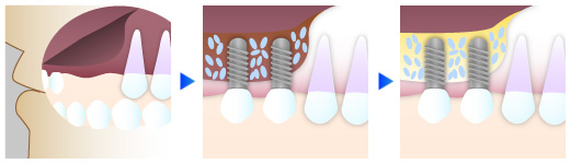 インプラント治療の手順