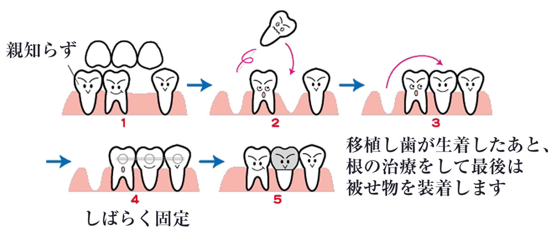 親知らずは抜歯をせずに保存