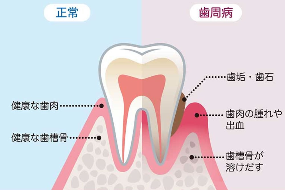 歯を失う原因1位の歯周病