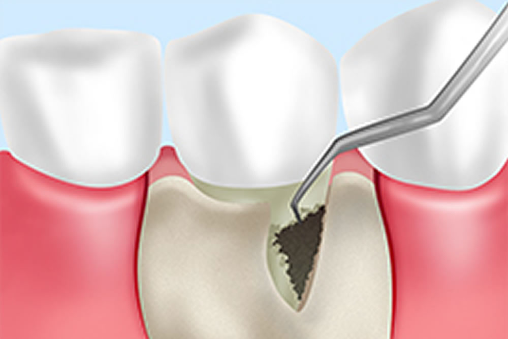 歯周炎
