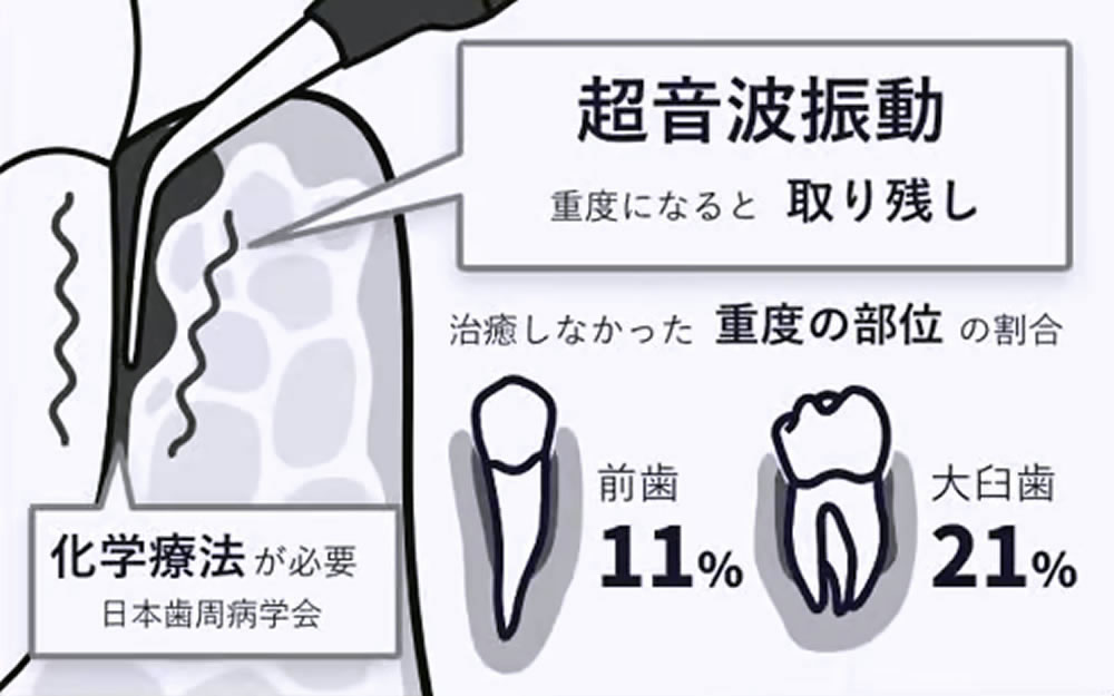 超音波振動のみ