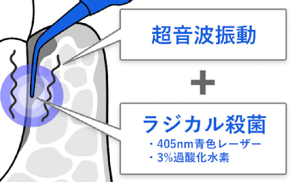 ブルーラジカル